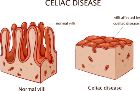 Celiac disease diagram